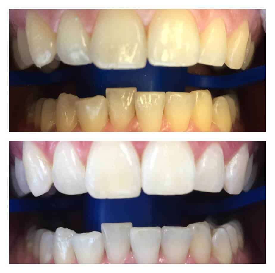 zoom teeth whitening prices