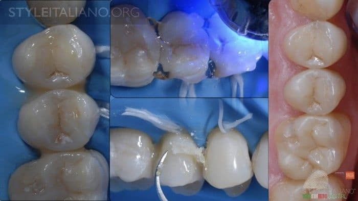 Dental Inlays &Amp; Overlays 2